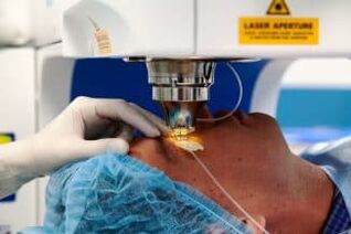 Opération de vision laser